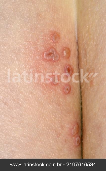 Herpes On The Buttocks Close Up Of Lesions O Latinstock