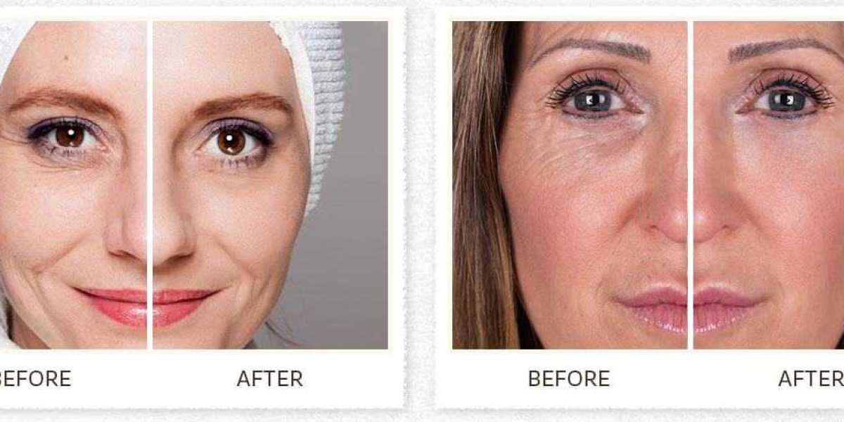 Lift Factor Plus - Removes Under-Eye Bags & Dark Circles