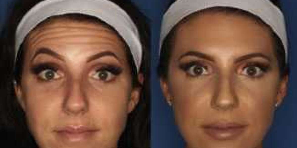 Microneedling Facial Near Me