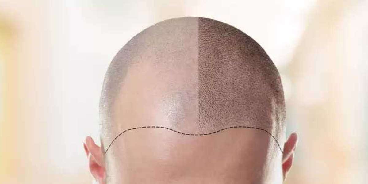 What is Hair Transplantation