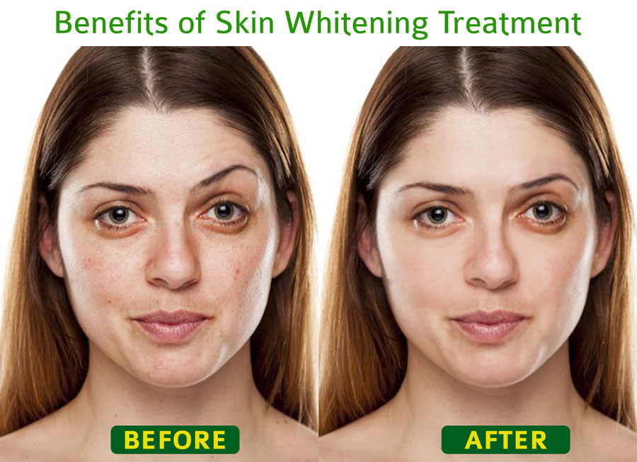 Skin whitening, laser skin treatment & skin tightening  in Gurgaon