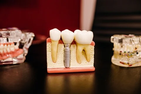 Cấy ghép Implant là gì? Lời khuyên về Implant của bác sĩ nha khoa Home – Nha Khoa Home