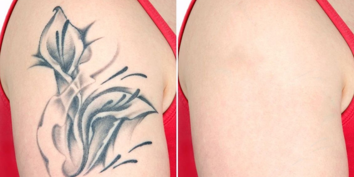 Releasing of New Products Have Spur the Industry; Claims The Tattoo Removal Market Insights Report