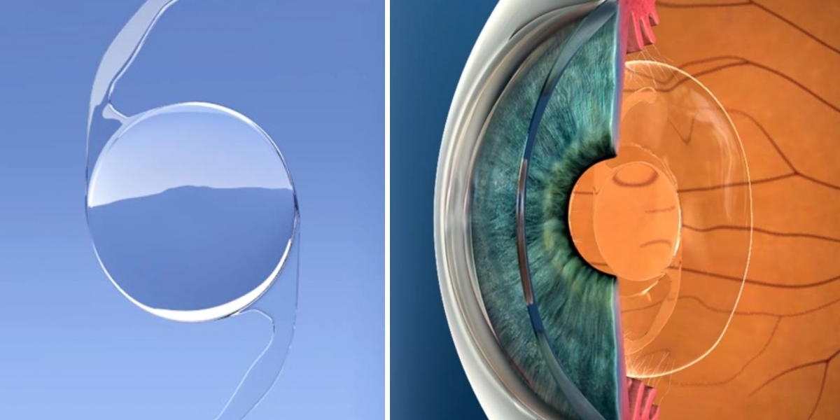 Global Intraocular Lens Market Insights with CAGR values, SWOT Analysis & Future Scope