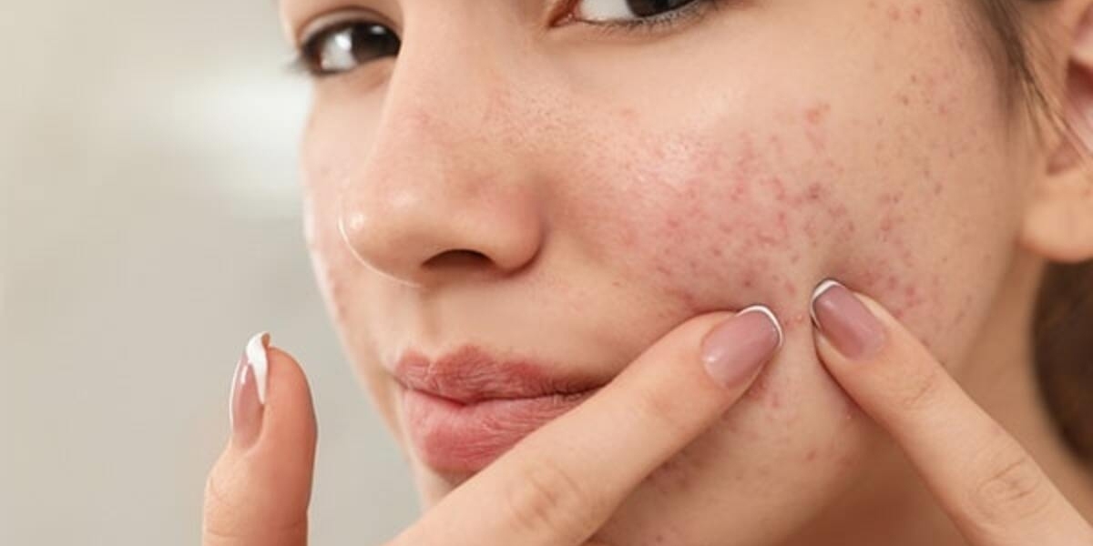 Effective Home Remedies to Treat Acne Naturally