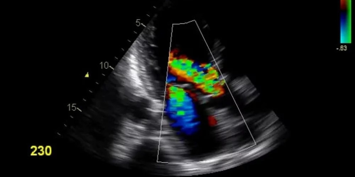 Color Doppler Test Centers Near Apollo Hospital Jasola