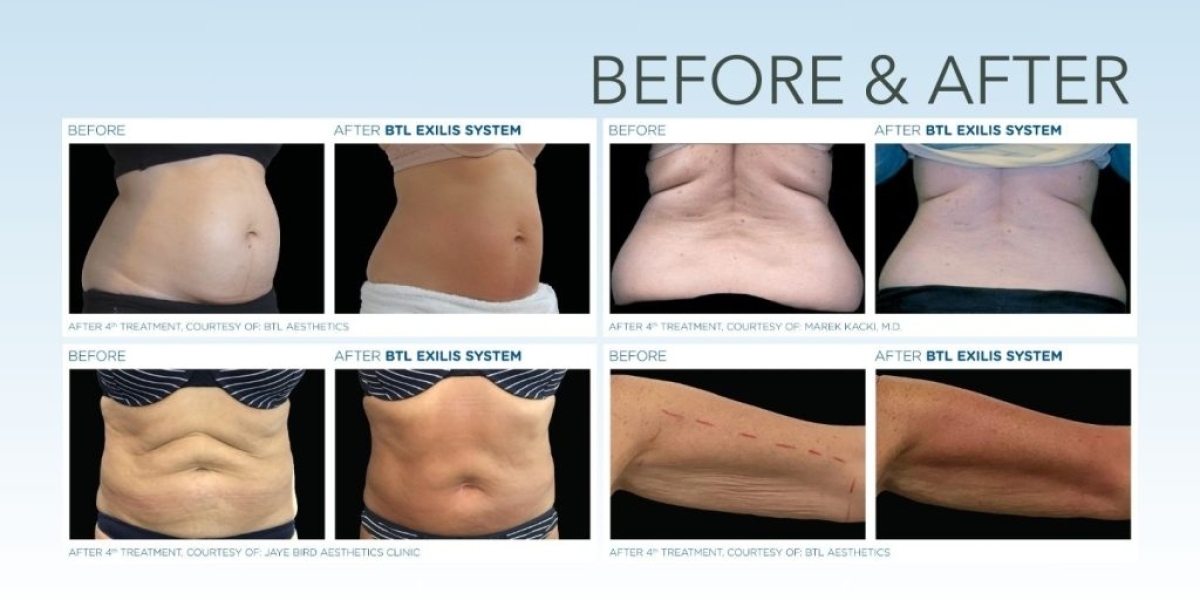 Experience Youthful Radiance: The Promise of Exilis Treatment