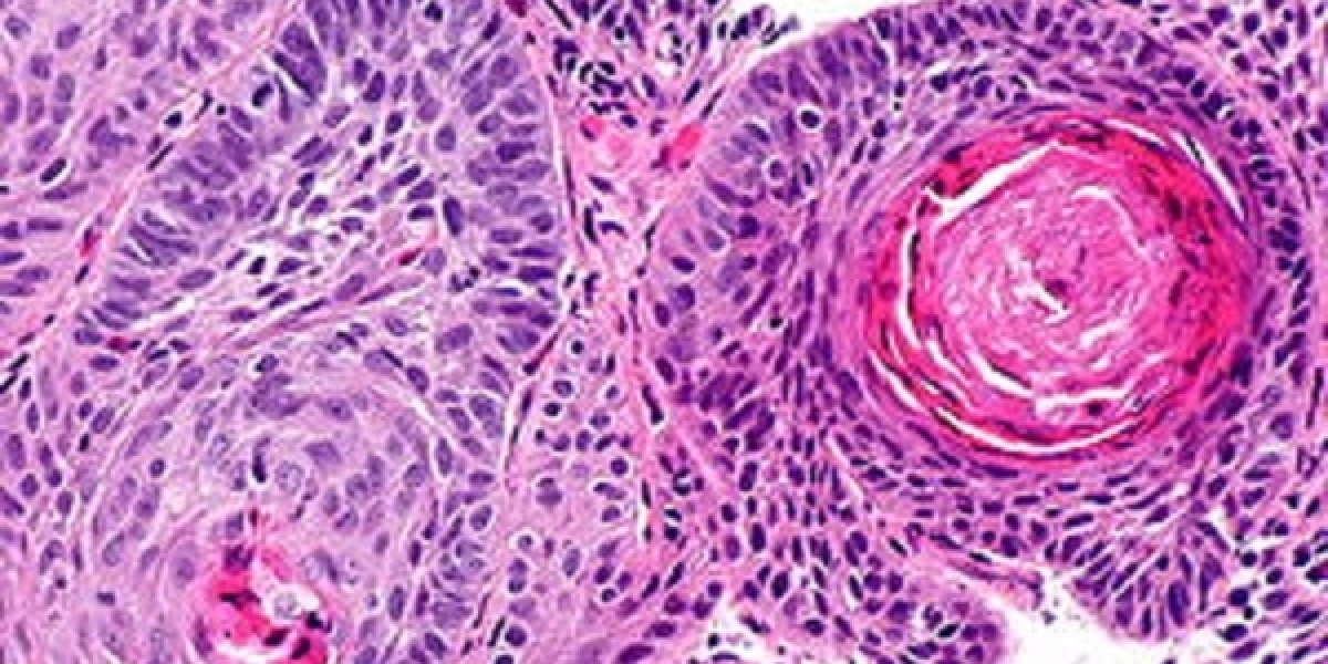 Esophageal Squamous Cell Carcinoma Market Share, Epidemiology, Analysis & Trends 2024-2034