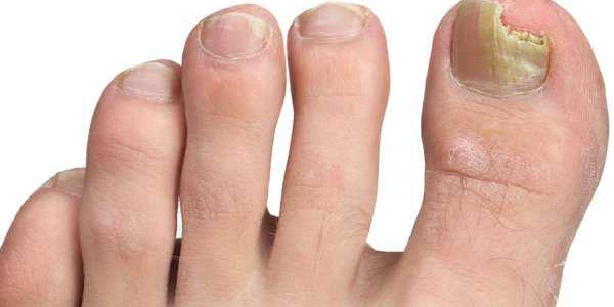 How to Know If Toenail Fungus Is Dying