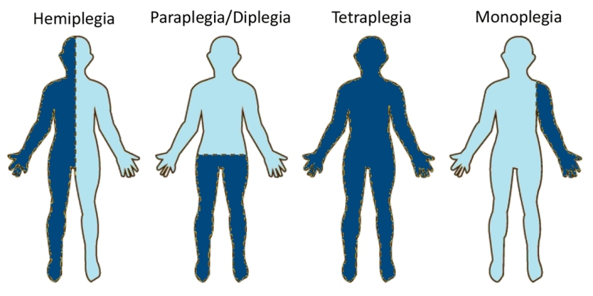 The Global Spastic Paraplegia 50 Market is driven by increasing research and development in neurological disorders