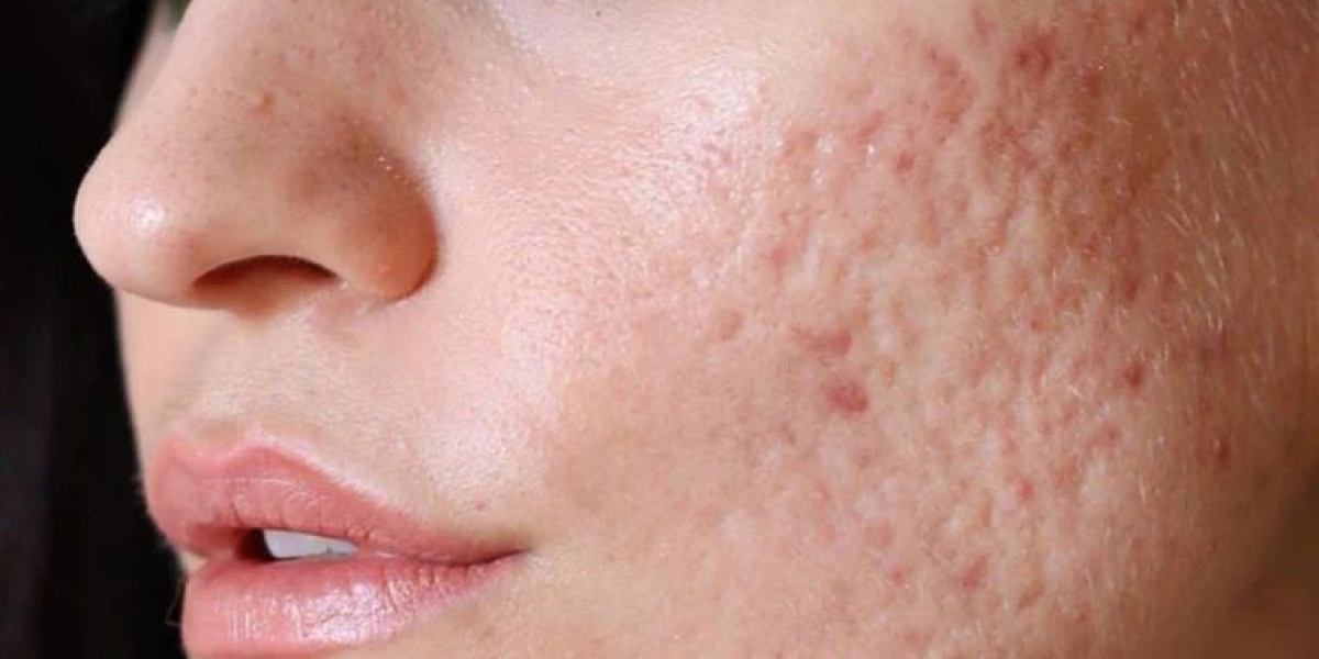 Dermatologist-Approved Treatments for Acne Scars