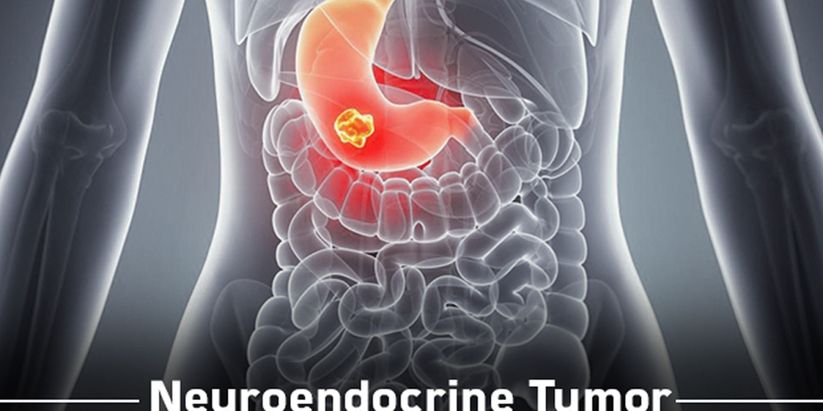 Neuroendocrine Tumor Treatment: Understanding Options for a Unique Cancer