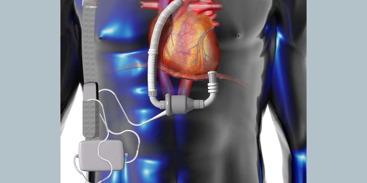 Exploring Growth Dynamics in the Global External Ventricular Drain Market