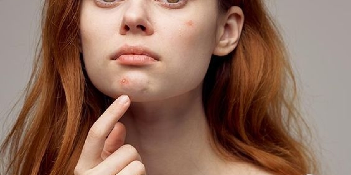 Methods for the Improvement of Acne Scars Used in Dermatology