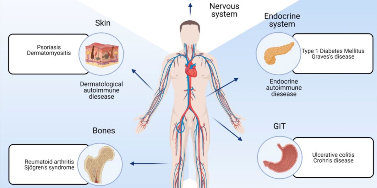 Understanding Growth Dynamics: Global Autoimmune Polyglandular Syndrome Type 1 Market Analysis