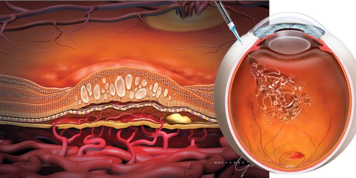 Hope for Eyes: Innovative Macular Degeneration Treatments Drive Market Growth