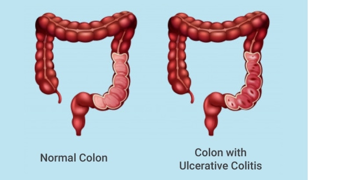 United Kingdom Ulcerative Colitis Industry: United Kingdom Faces Rising Economic Burden of Ulcerative Colitis