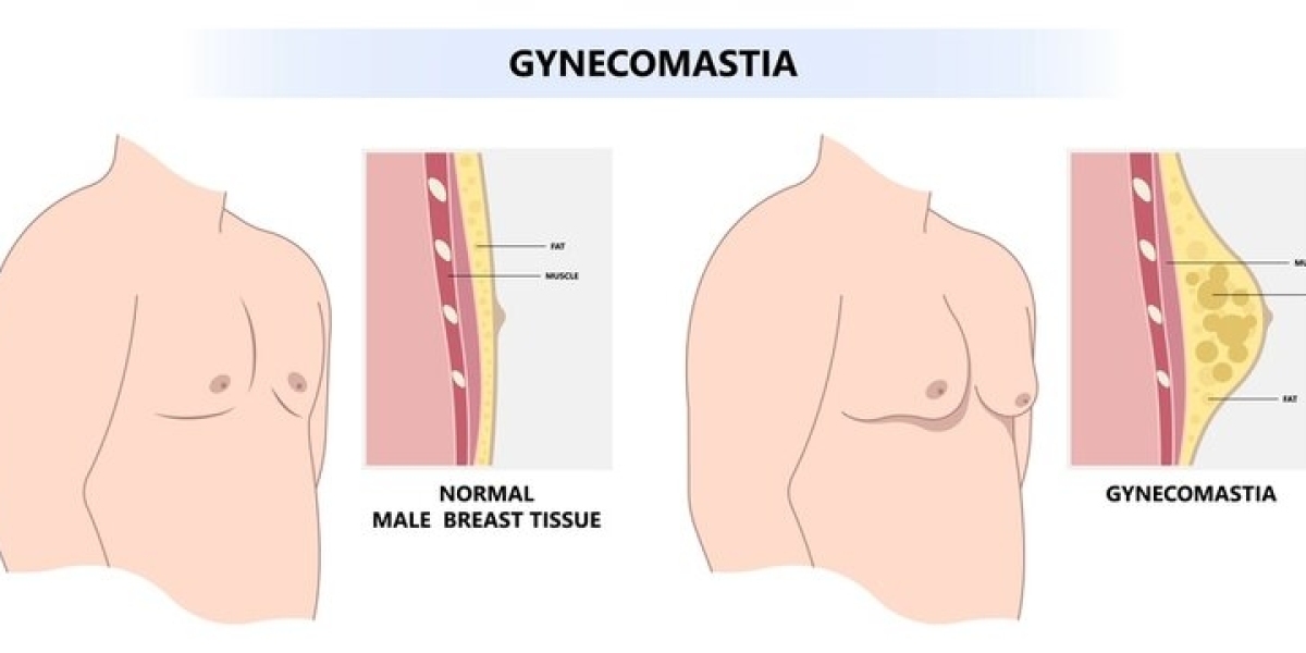 Minimally Invasive Options on the Rise: The Changing Landscape of Gynecomastia Treatment