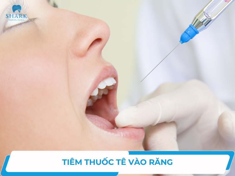 Tiêm thuốc tê khi nhổ răng có những tác dụng phụ nào?