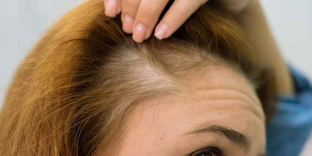 Exploring the Latest Advancements in Female Hair Transplant in Dubai