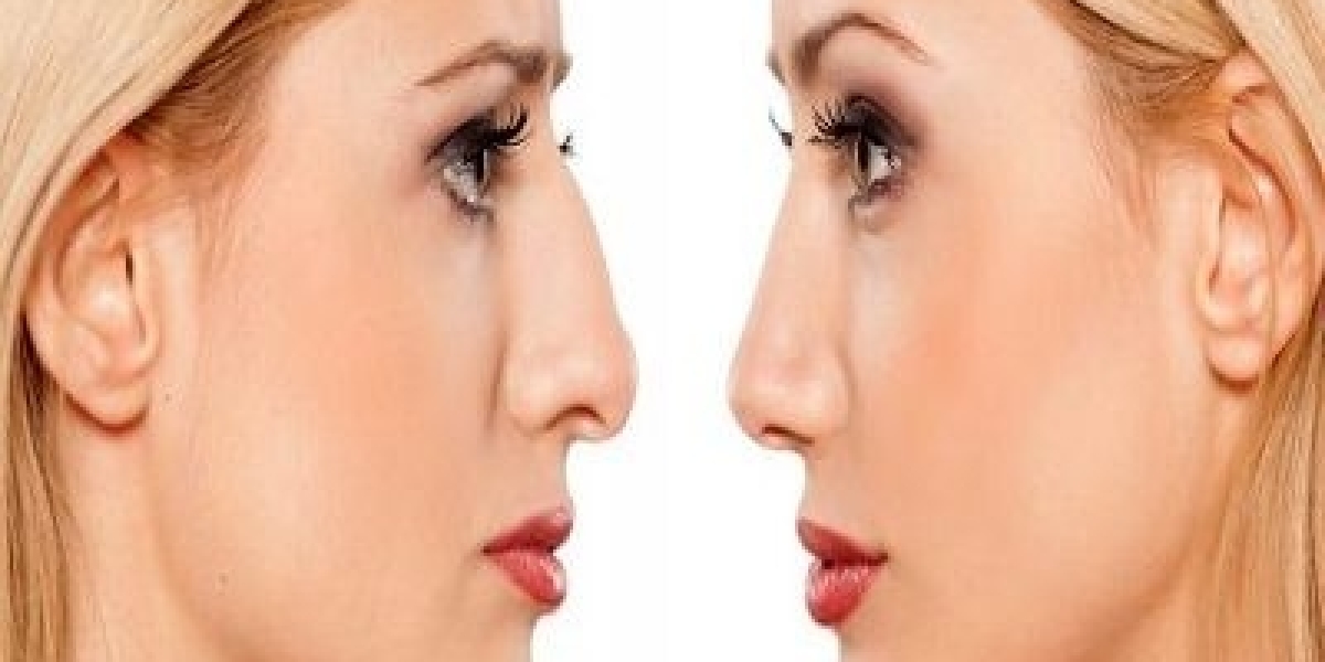 7 Common Myths about Nose Tip Plasty in Dubai Debunked