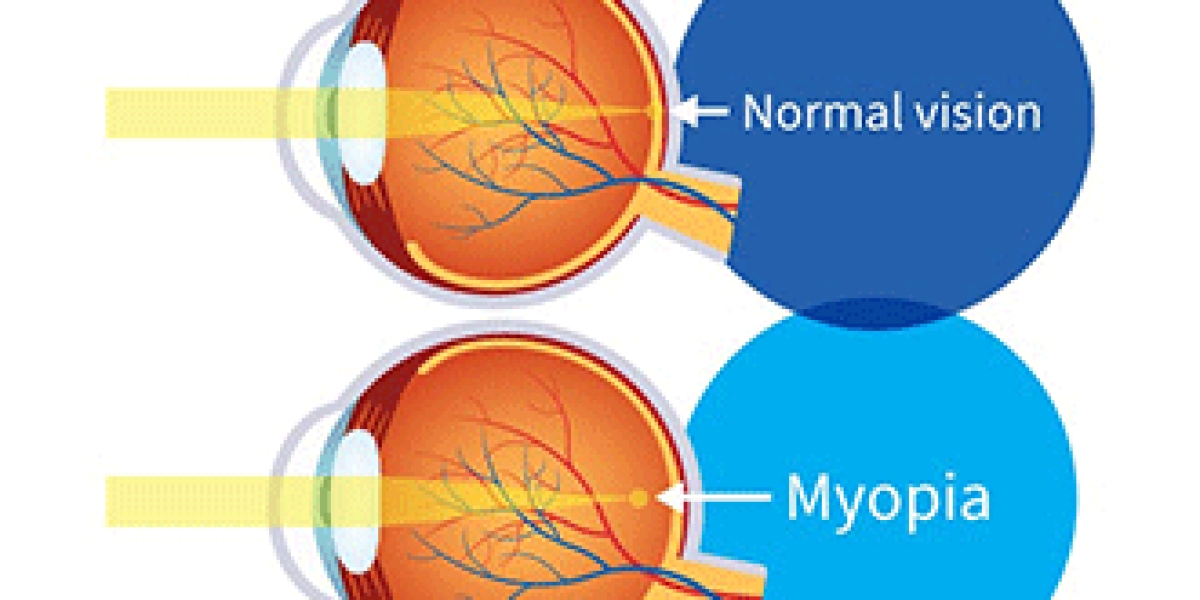 Myopia Market Size 2024: Epidemiology, Industry Trends and Forecast by 2034