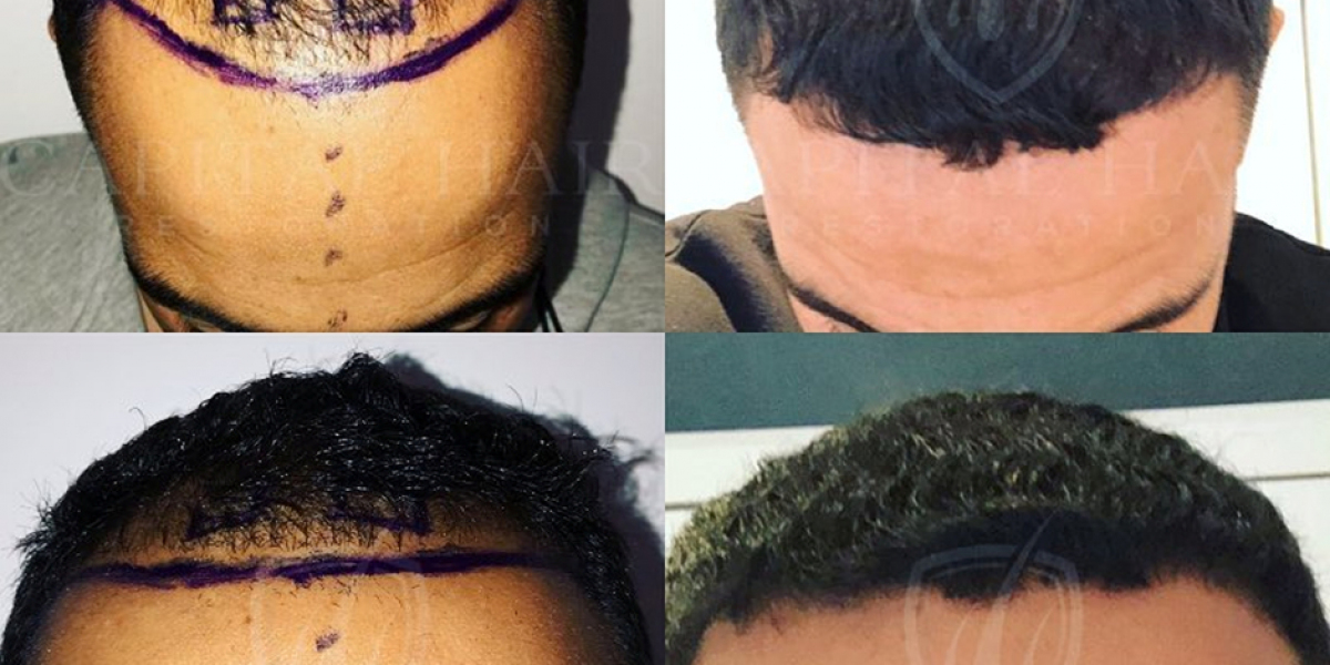 Why Choose Turkey Over the UK for Your FUE Hair Transplant: Key Reasons Explained