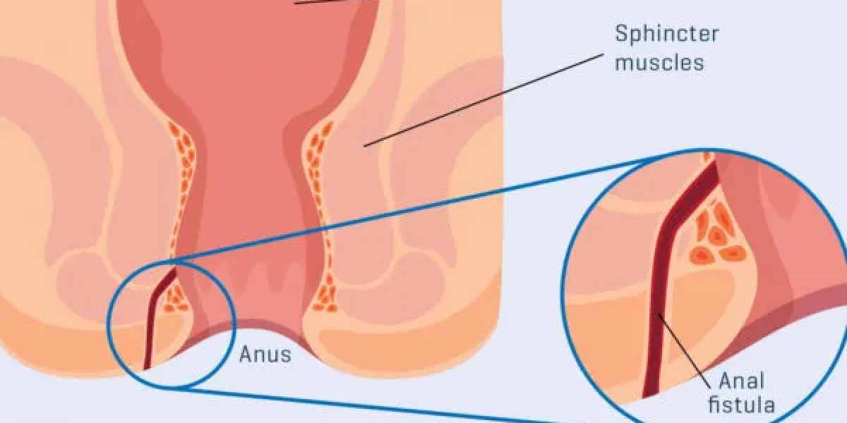 Comprehensive Guide To Choosing The Right Fistula Surgeon Mumbai