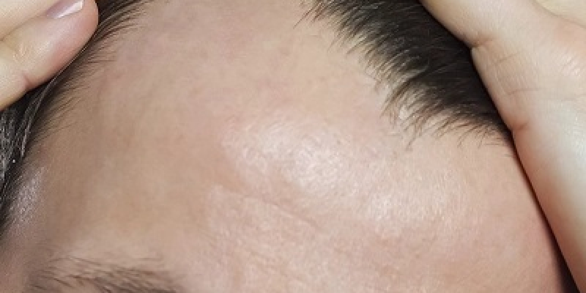 How Can I Solve My Hair Loss?