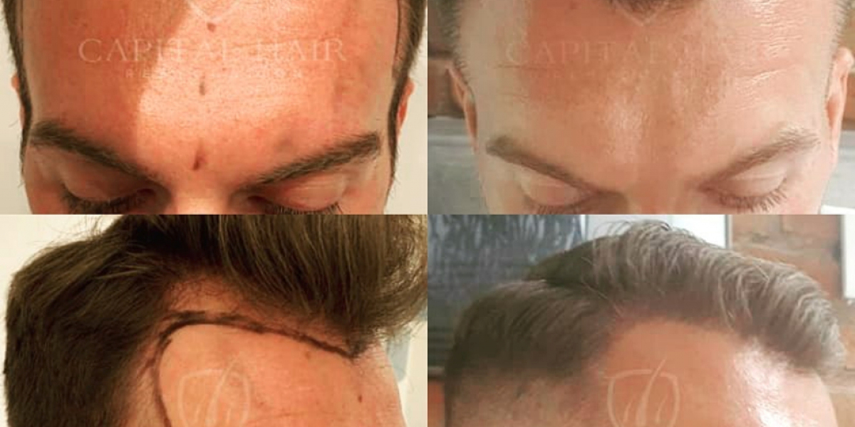 Why Should You Choose Southampton for the Best Hair Transplant Results?