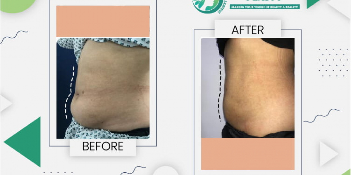 Liposuction in Lahore: Transform Your Body with Cosmeticoplasty