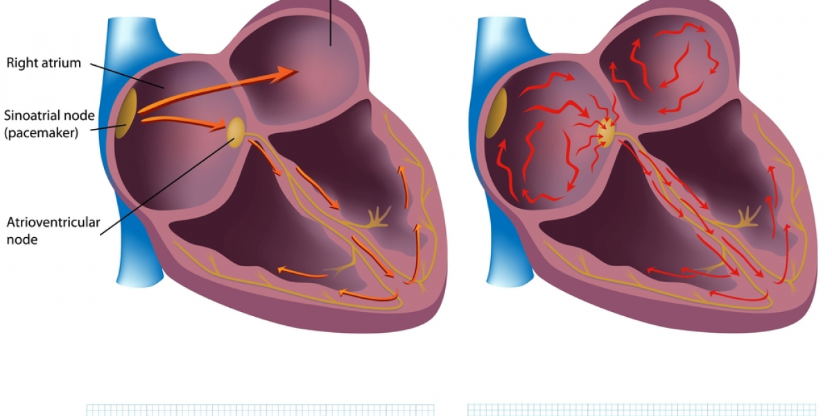 Atrial Fibrillation Market Growth: Key Drivers and Trends Through 2032