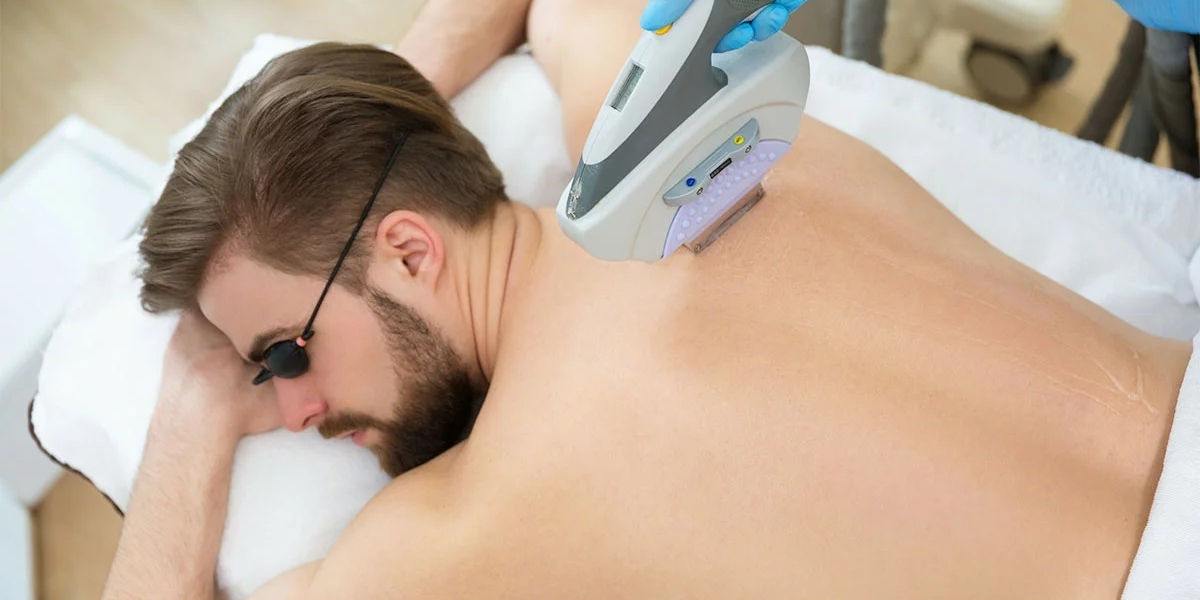 What is the theory of laser hair removal?