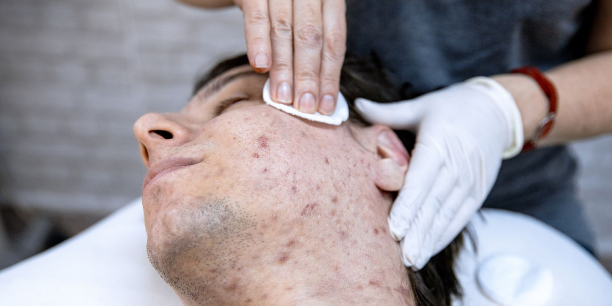 Acne Treatment Market Size Expansion to Drive Significant Revenues in the Future