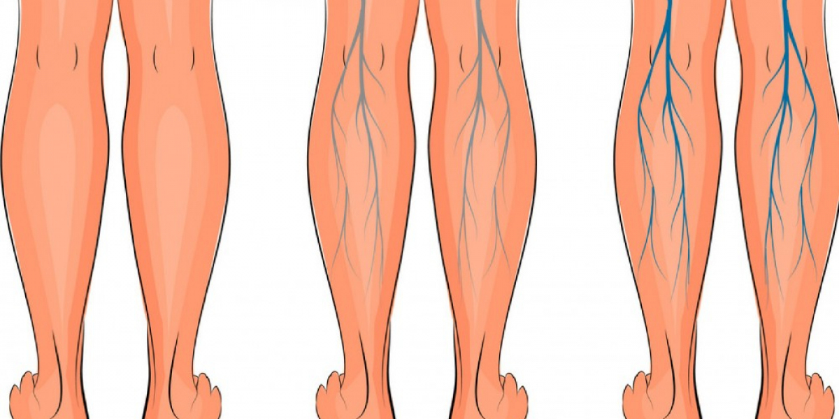 Varicose Veins Treatment: Patient Preferences and Treatment Options