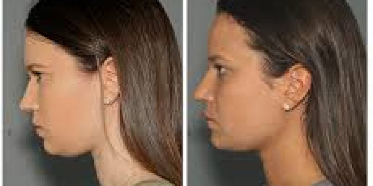 Neck Liposuction NYC: Achieving a Sculpted Jawline and Sleeker Neck