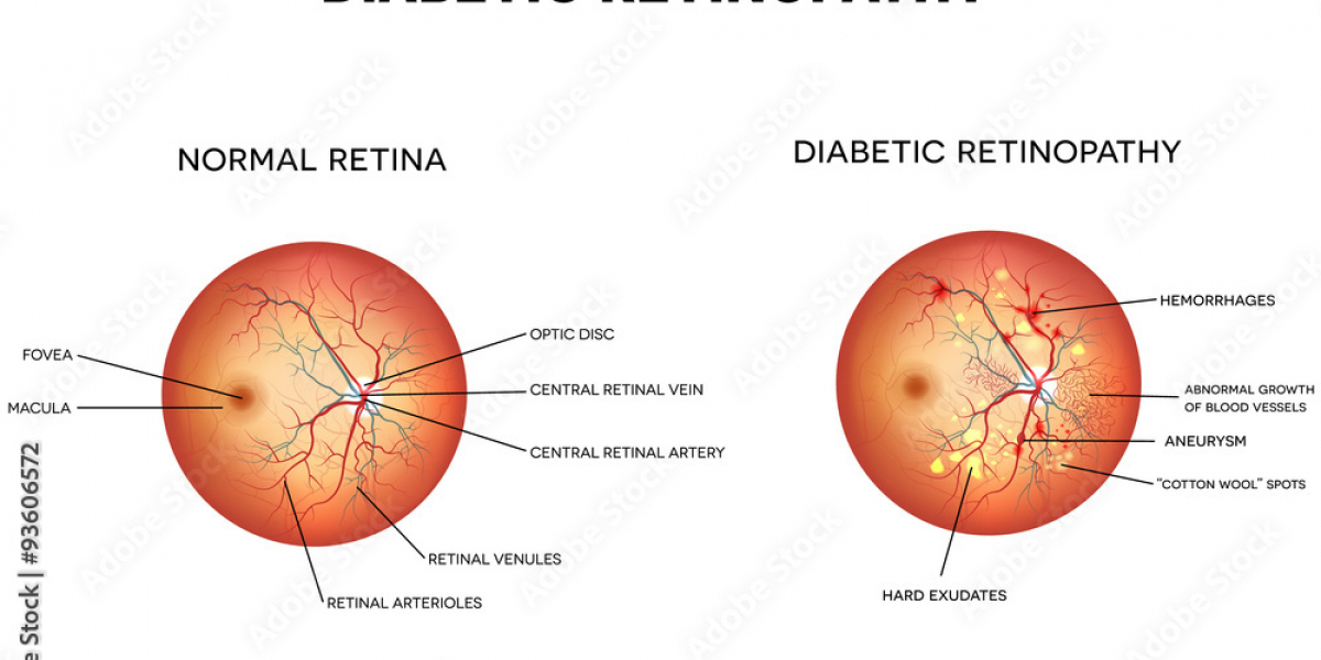 Understanding Diabetic Retinopathy: How Diabetes Affects Your Eyes