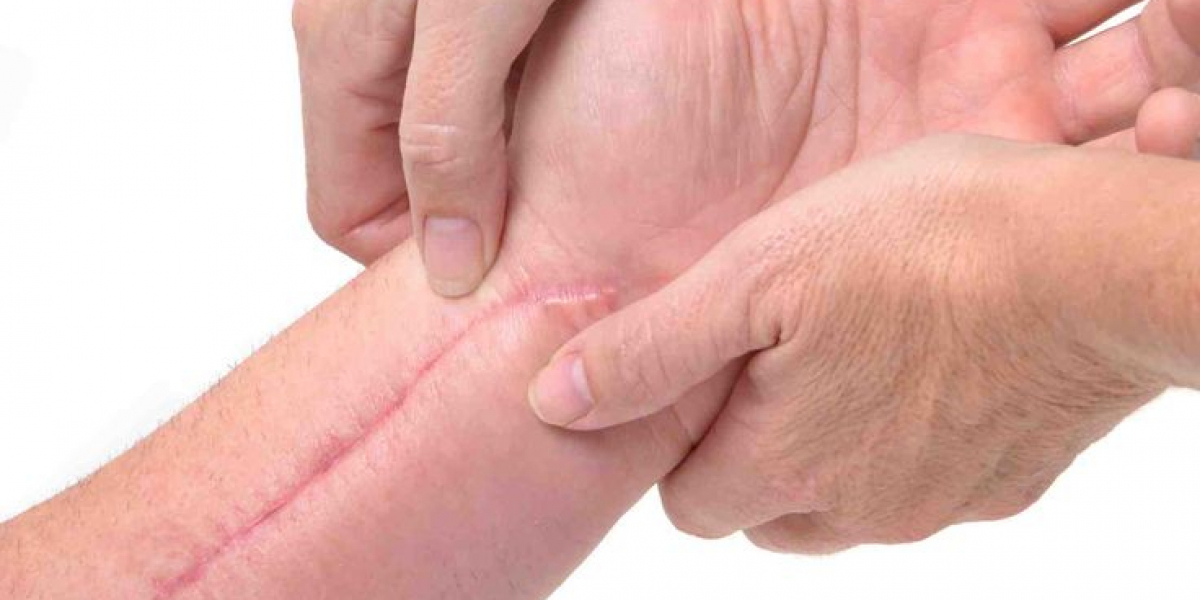 Caring for Your Wound Post-Stitch Removal: Is It Painful?