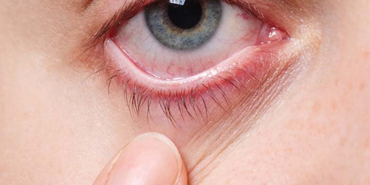 Understanding Corneal Transplant Surgery and Consultant Ophthalmologists in Dubai