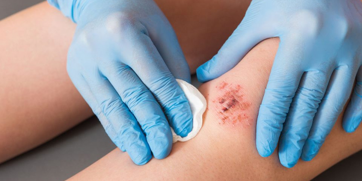 Wound Healing Market Size, Industry Research Report 2023-2032