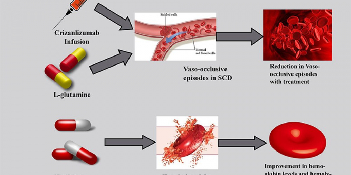 Sickle Cell Disease Treatment Market Size, Share, Growth Analysis Report 2033