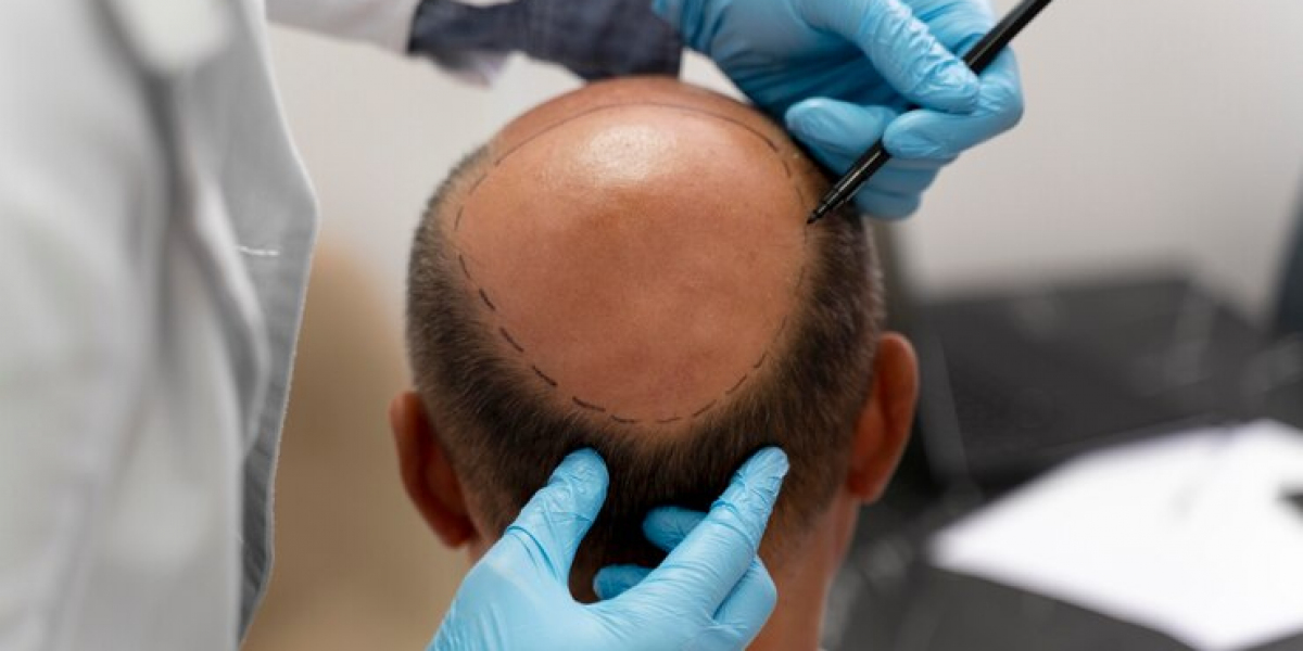 Grasping Hair Density: How Many Grafts Do You Need for a Successful Hair Transplant?