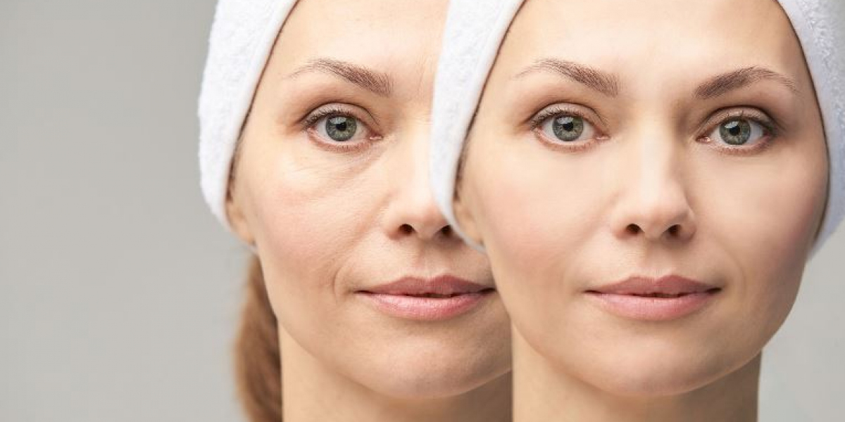 Transforming Tired Eyes: The Impact of Tear Trough Filler Treatment