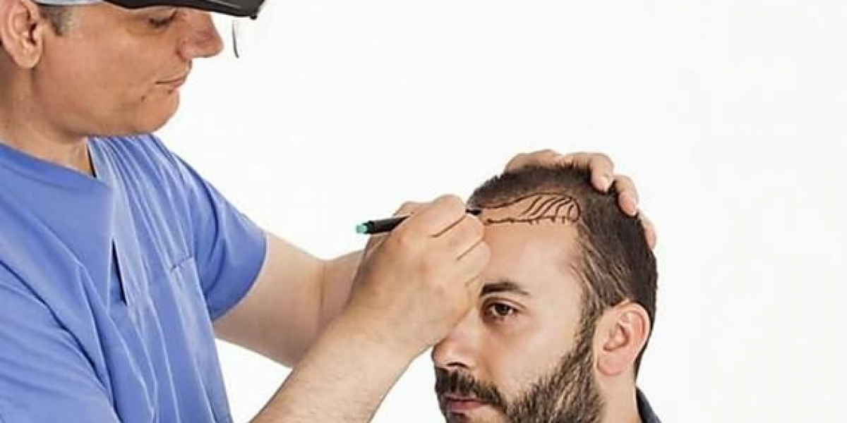 How to Manage Expectations: What Hair Transplants Can and Cannot Do