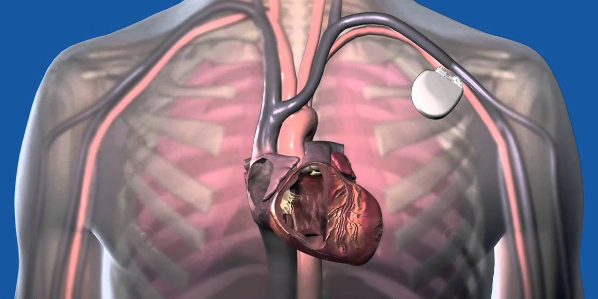 Cardiac Pacemaker Market Assessment and Future Growth Strategies 2024 – 2032