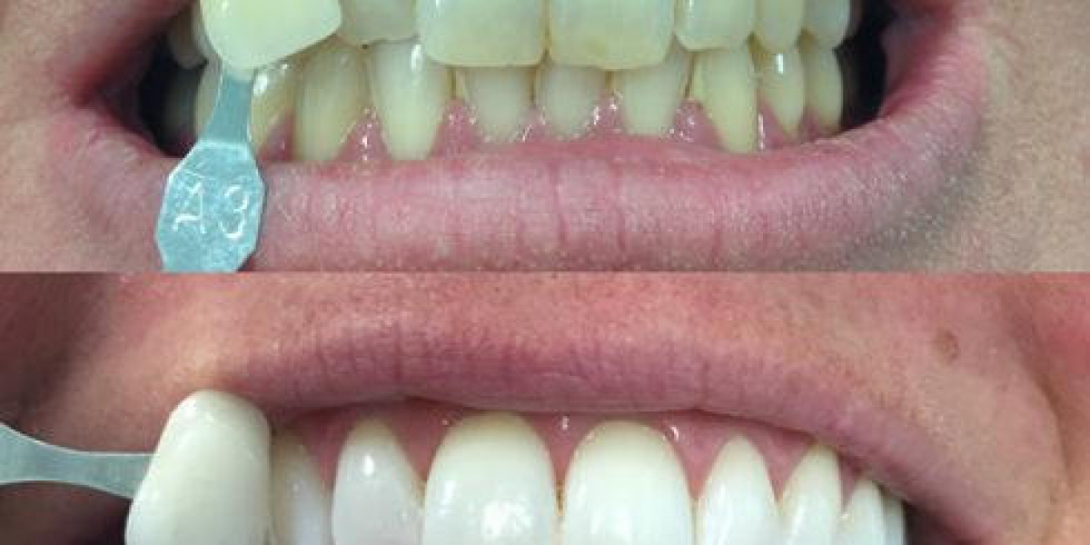 Looking for a Whiter Smile? Crest 3D White UK Has You Covered!