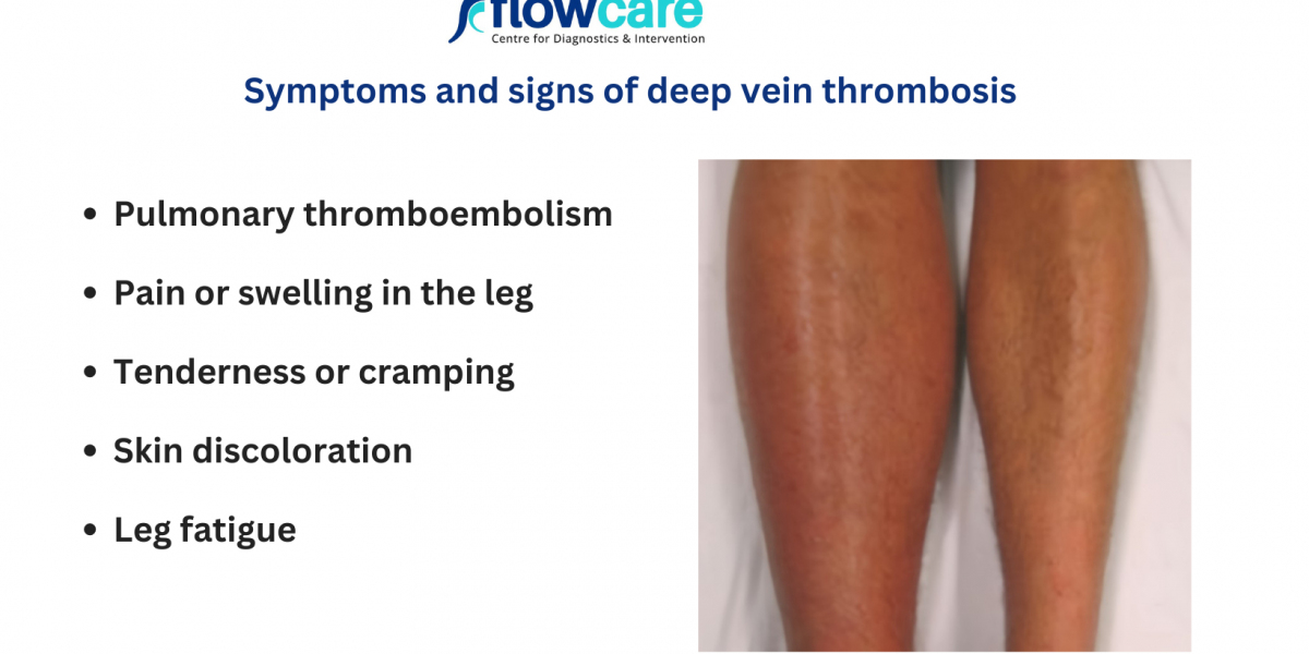 Recognizing DVT Symptoms: What You Need to Know