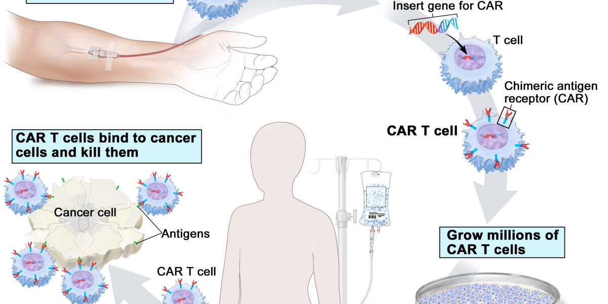 Exploring The Risks and Benefits of CAR T-Cell Therapy in Cancer Treatment