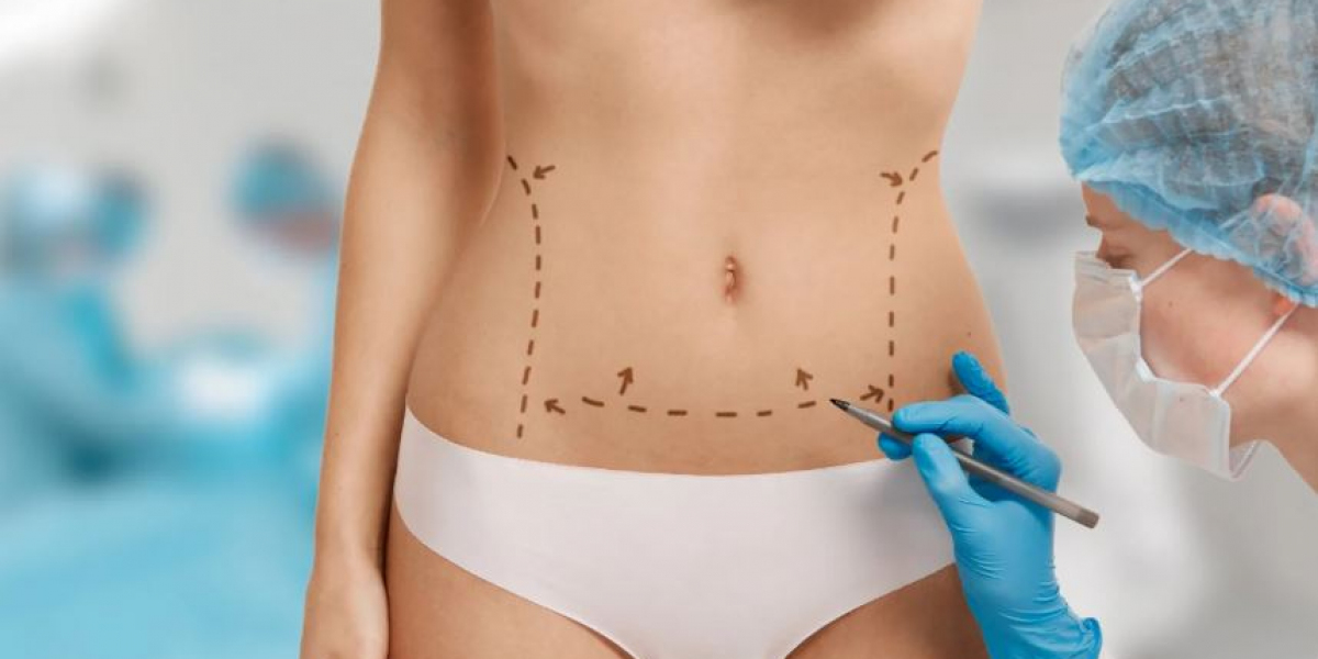 Finding the Best Tummy Tuck Surgeon for Your Transformation