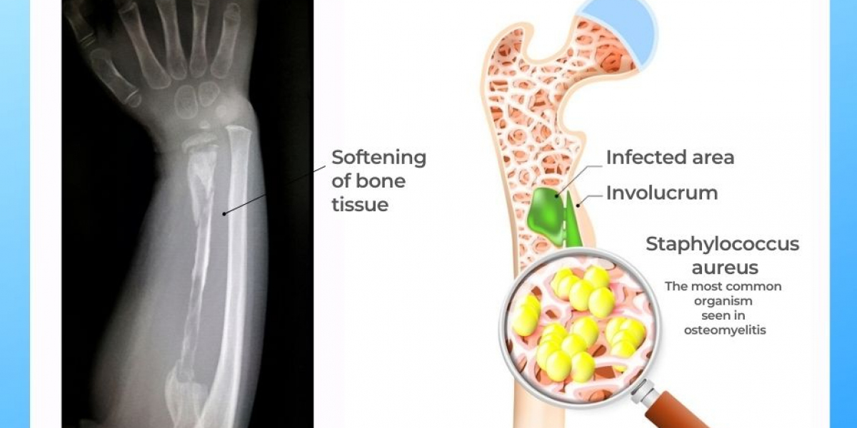 Osteomyelitis: Causes, Symptoms, and Effective Treatment Options